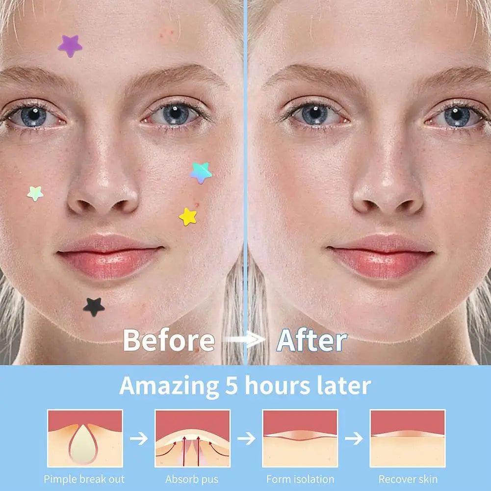 Étoile Colorée Bouton Patch Acné Coloré Invisible Acné Élimination Soins de la Peau Autocollants Correcteur Visage Spot Beauté Outils de Maquillage