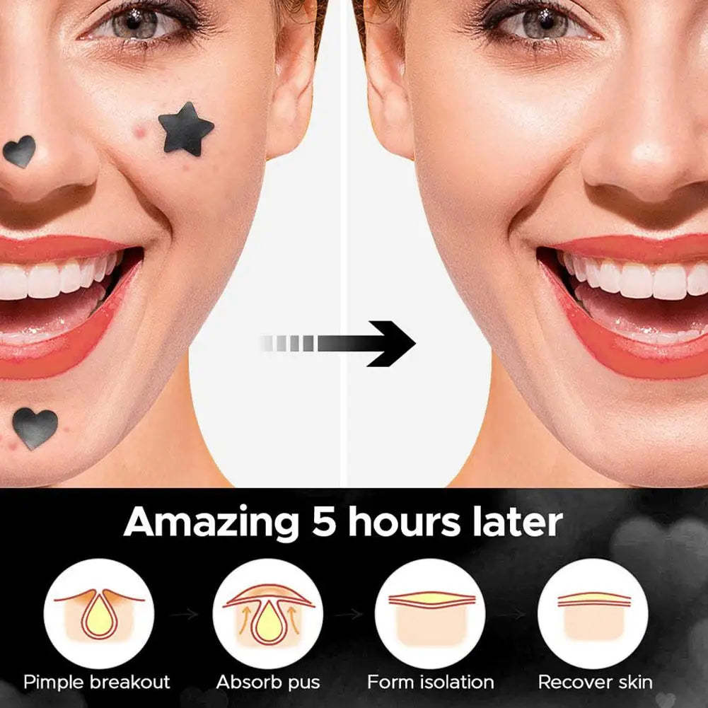 Étoile Colorée Bouton Patch Acné Coloré Invisible Acné Élimination Soins de la Peau Autocollants Correcteur Visage Spot Beauté Outils de Maquillage